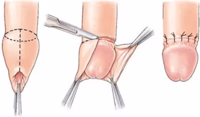 Cirkumcizija - obrezovanje penisa
