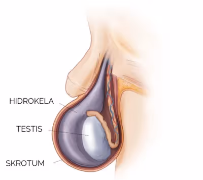 Operacija hidrokele (vodene kile)