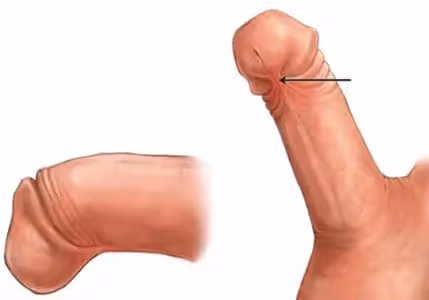 Prerez frenuluma (frenulotomija)