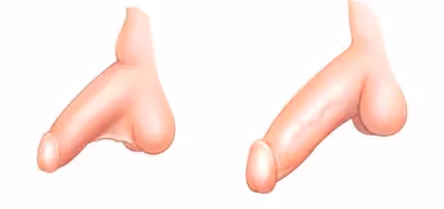 Odstranitev odvečne kože mošnje - Redukcija skrotuma