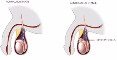 Operacija spermatokele