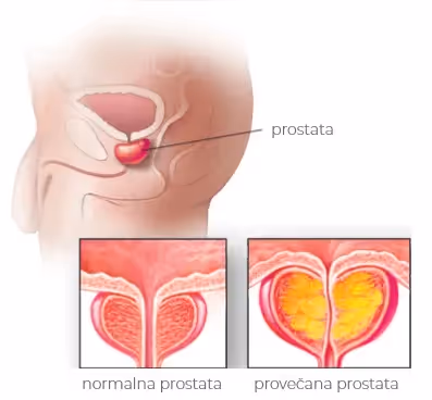 Benigna hiperplazija prostate (BHP)