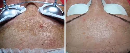 alt="Poseg odstanjevanja hiperpigmentacije