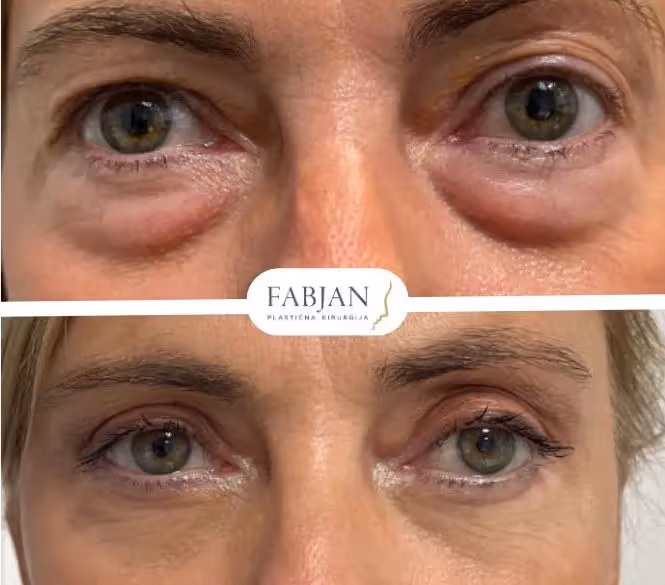 Prej in potem slika obraza pacientke, ki je opravila dvojno blefaroplastiko.
