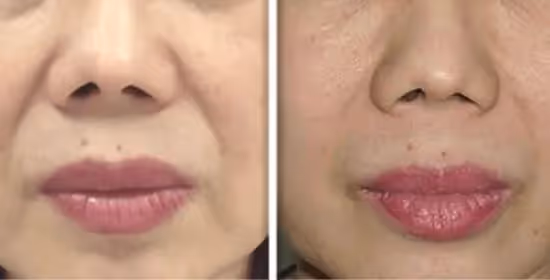 lasersko pomlajevanje