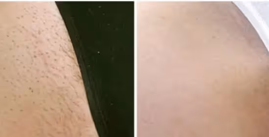 lasersko odstranjevanje dlak