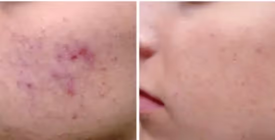 lasersko zdravljenje aken