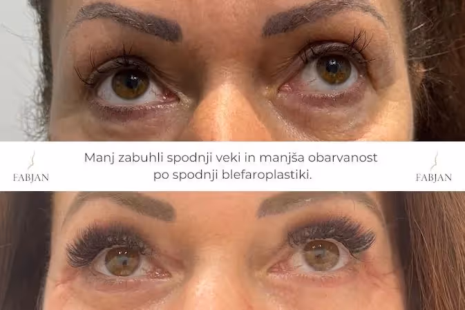 Slika pred in po operaciji spodnjih vek. 