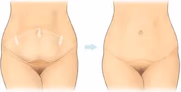 abdominoplastika cena