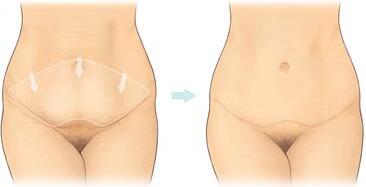 abdominoplastika cena
