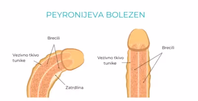 Slika penis s peyronijevo boleznijo
