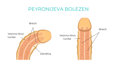 Slika penis s peyronijevo boleznijo
