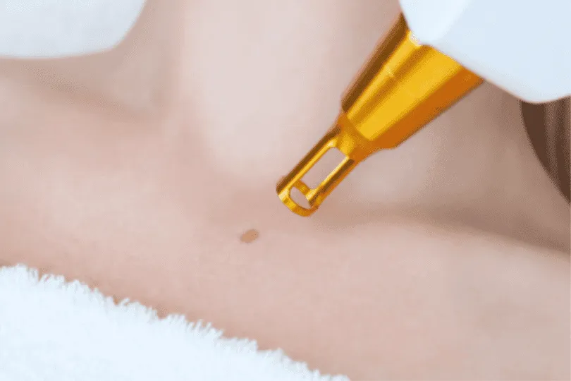 odstranitev znamenja