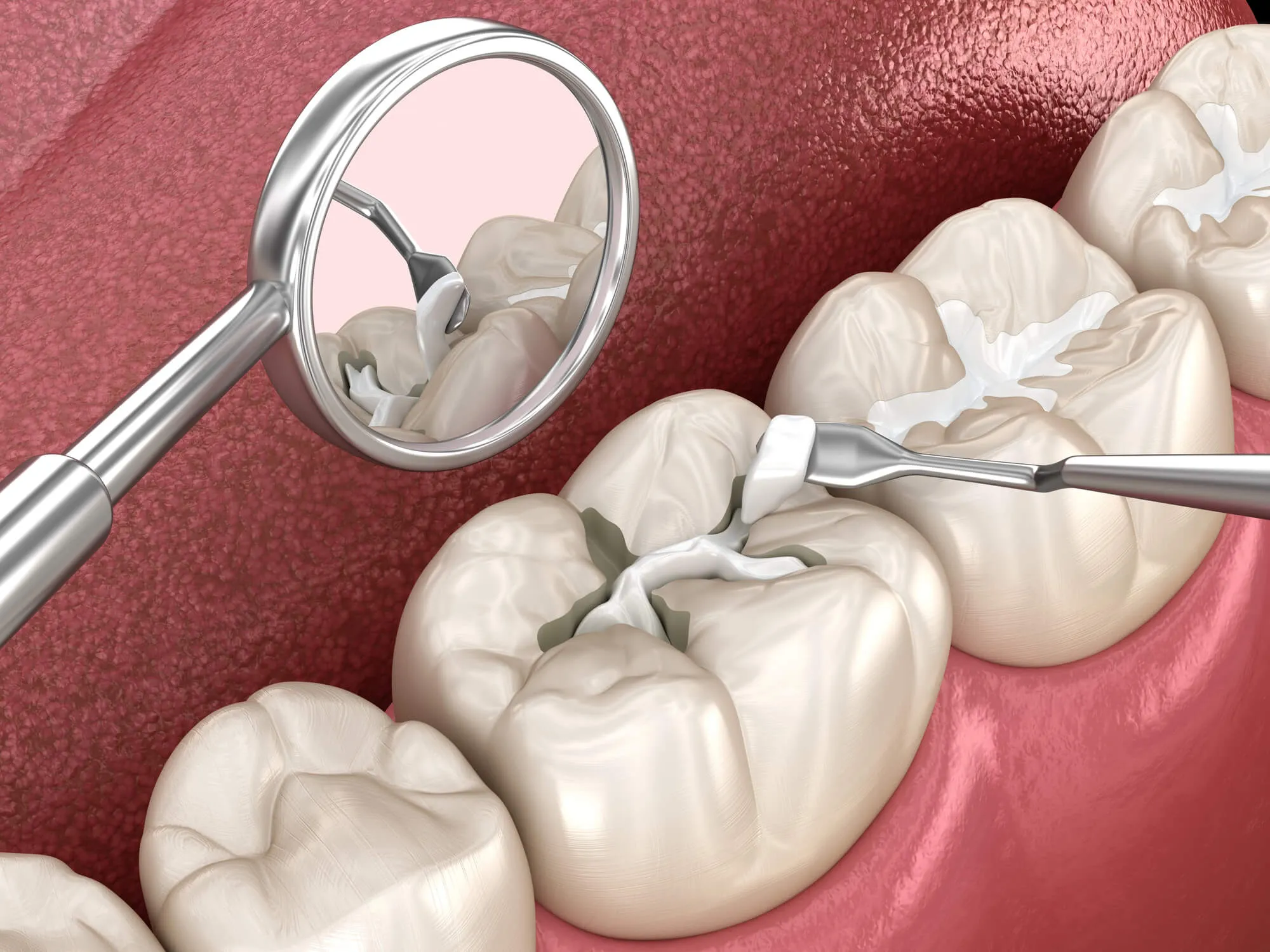 Composite fillings college station tx illustration
