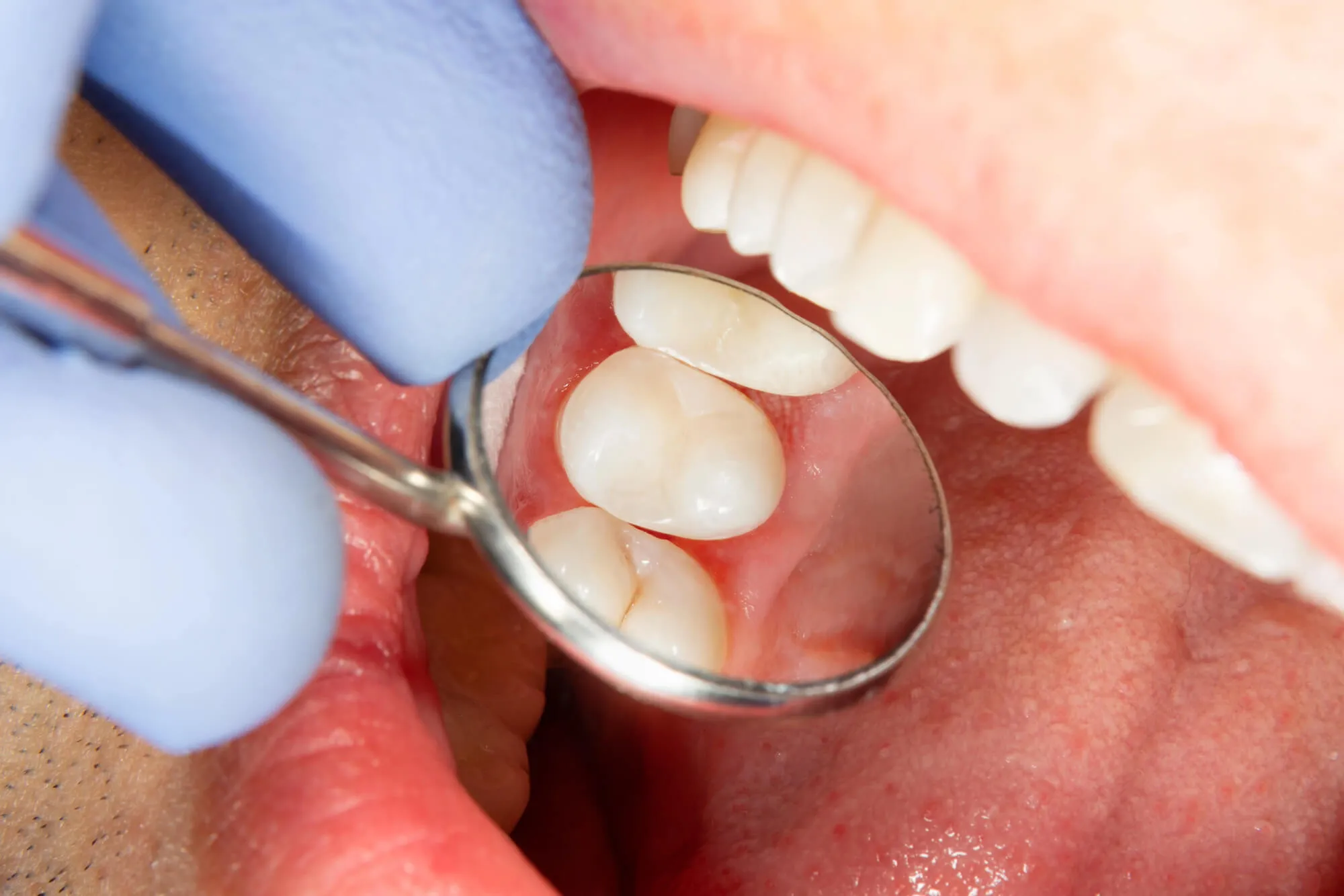 What Can Cause a Filling to Wear Down Over Time?