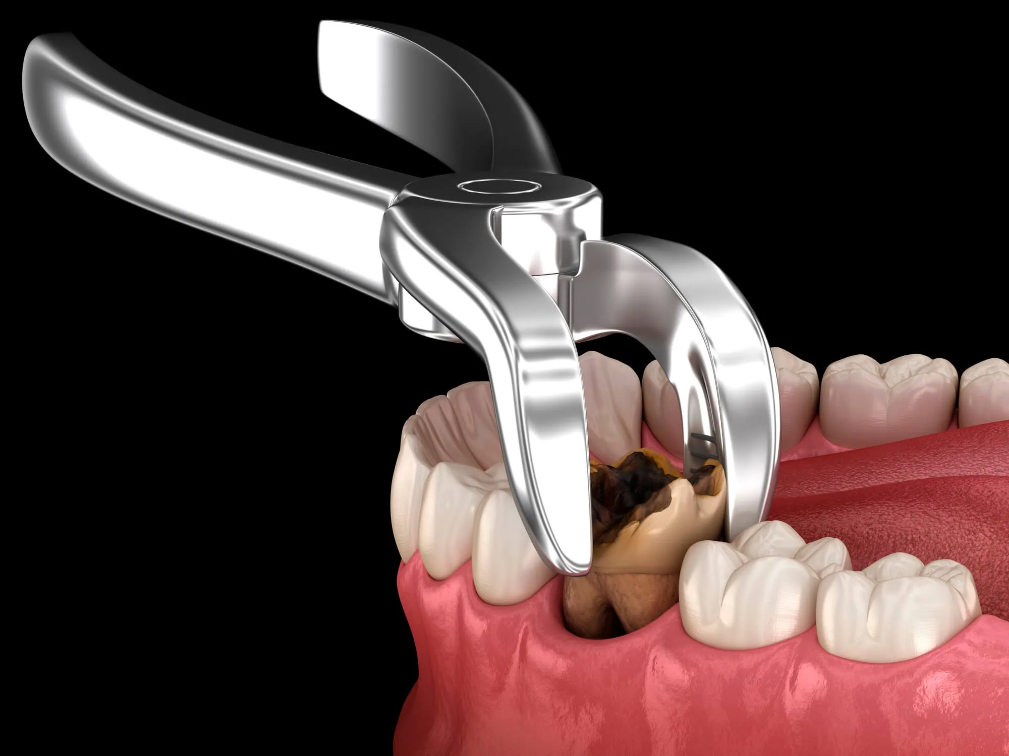 Tooth extraction college station tx illustration