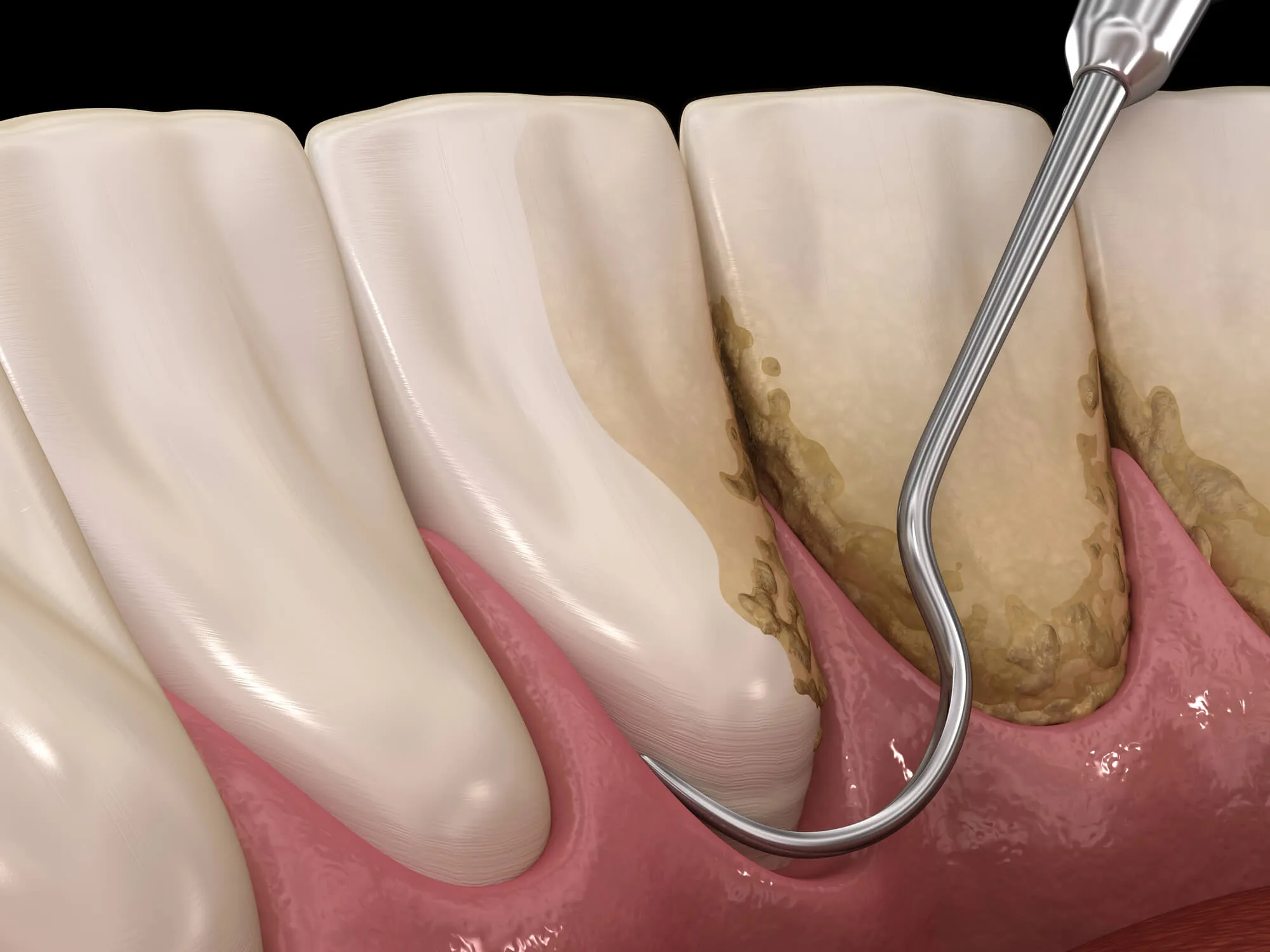 dentist in hueytown al performs scaling and root planing