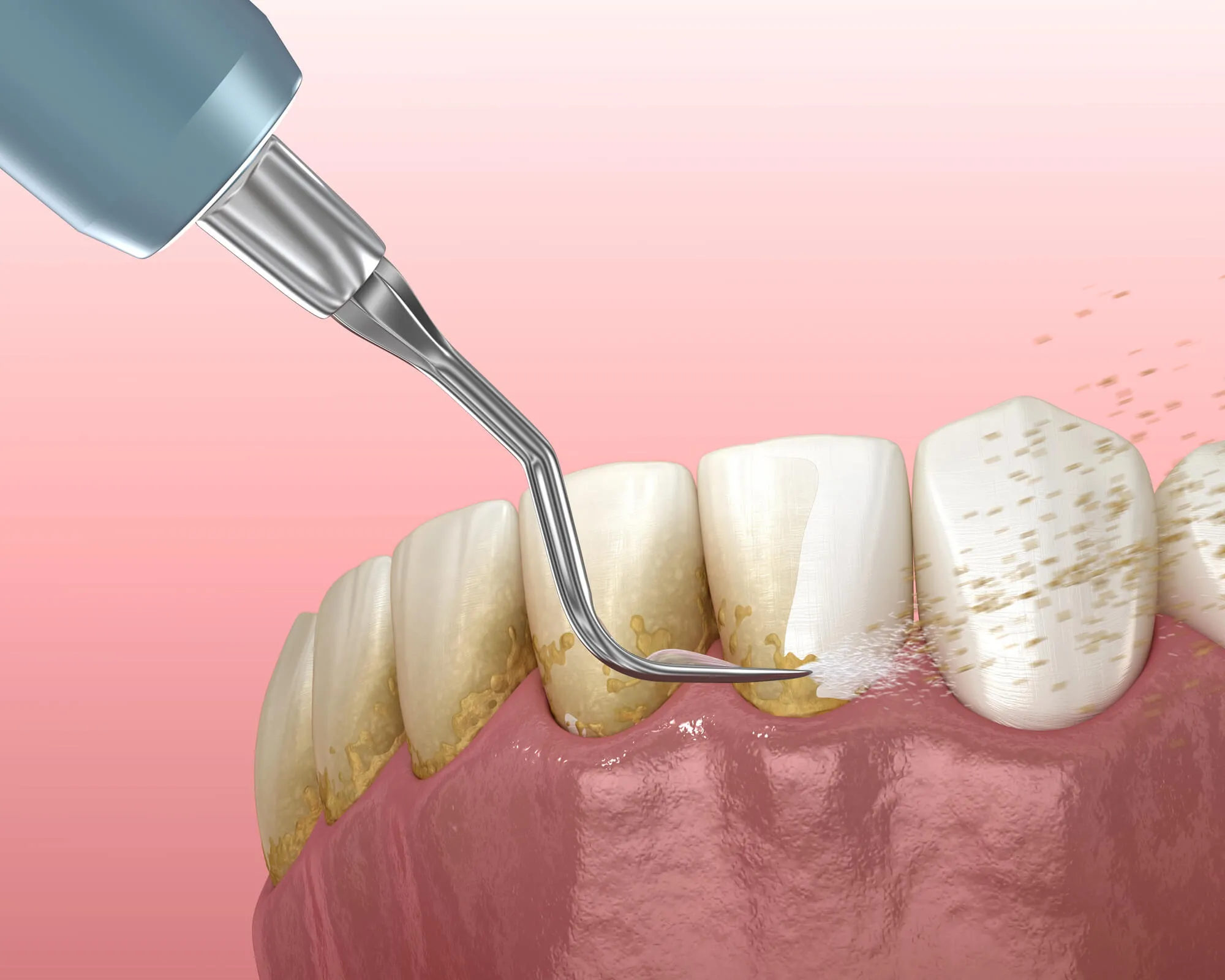 dentist in hueytown al performs deep clean