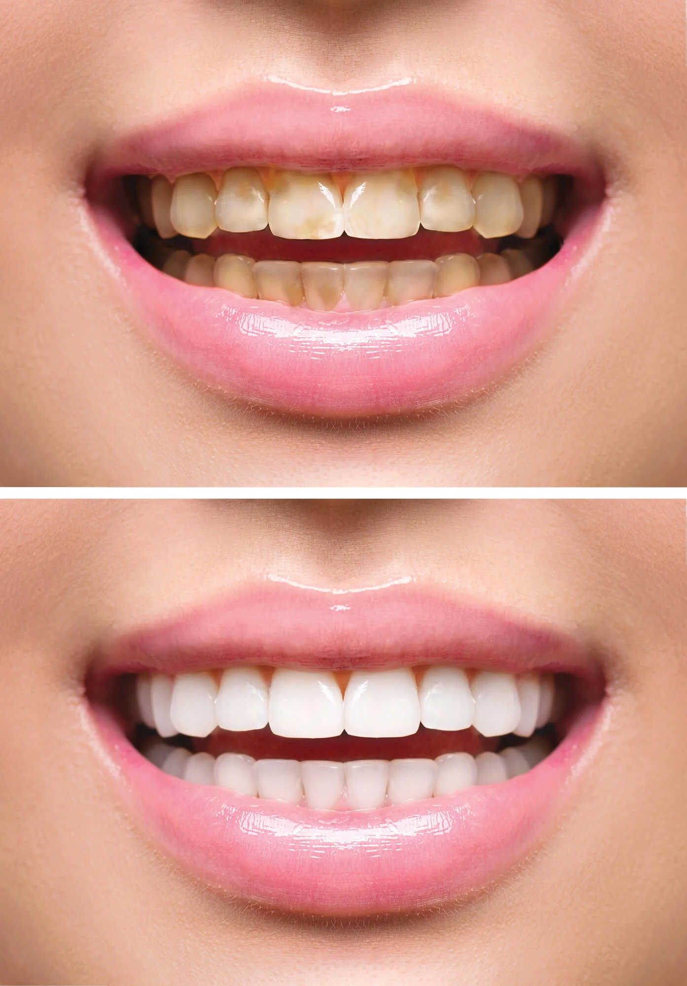 Before and after results from teeth whitening in Birmingham