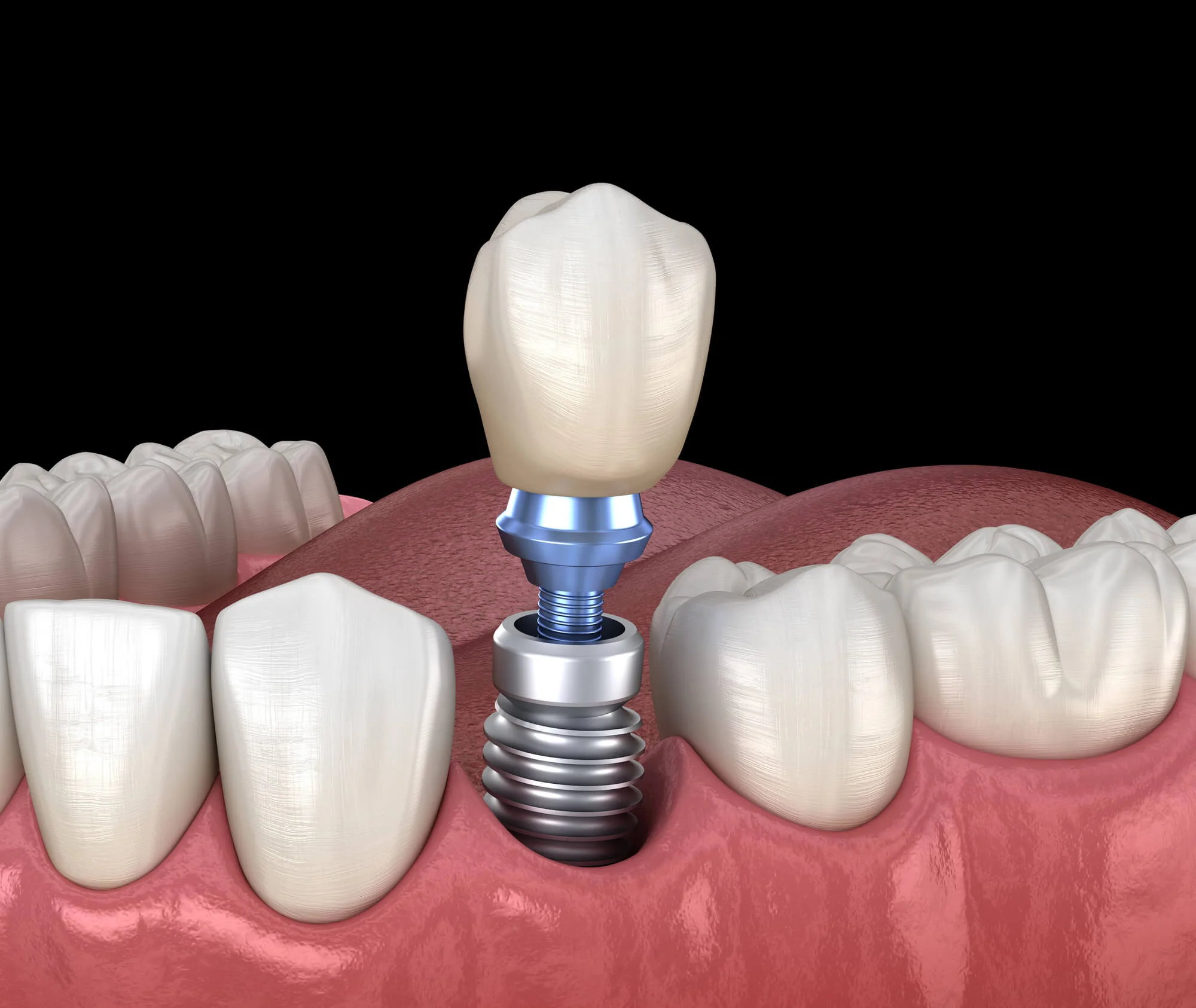 Dental implants in Birmingham replace missing teeth
