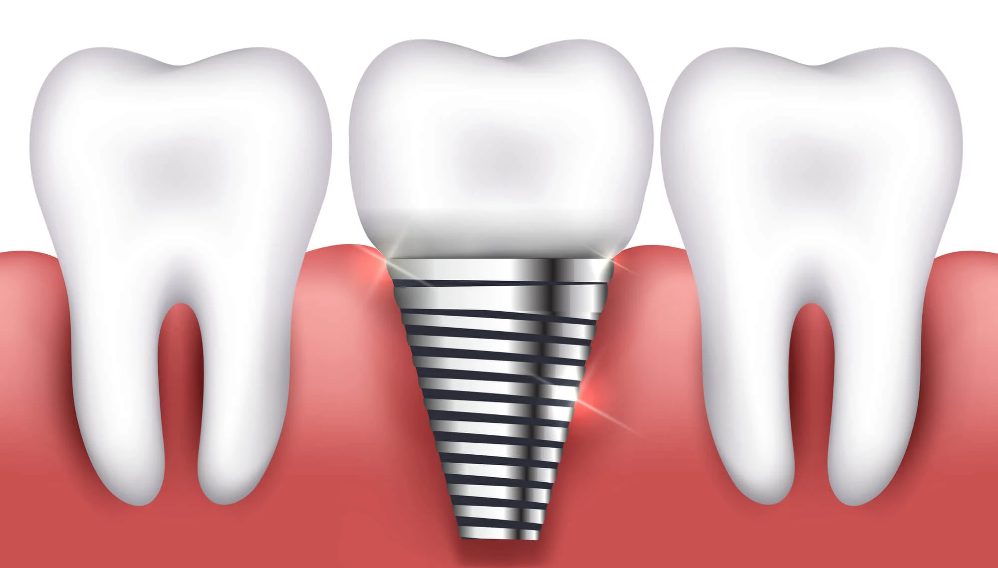Single dental implants in Birmingham