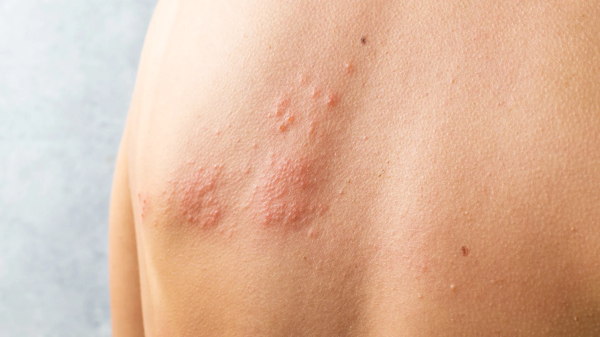 Red blistering rash on skin caused by the shingles virus