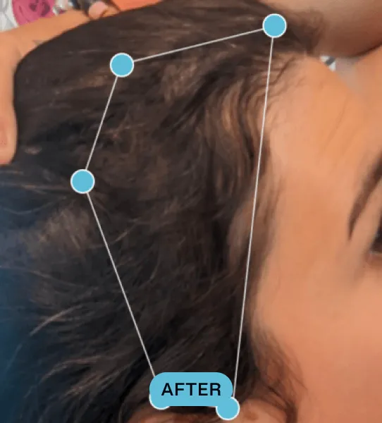 Close-up of a person's hairline and forehead showing hair growth improvement, with blue dots connected by lines forming a polygon and a label reading 'AFTER'.
