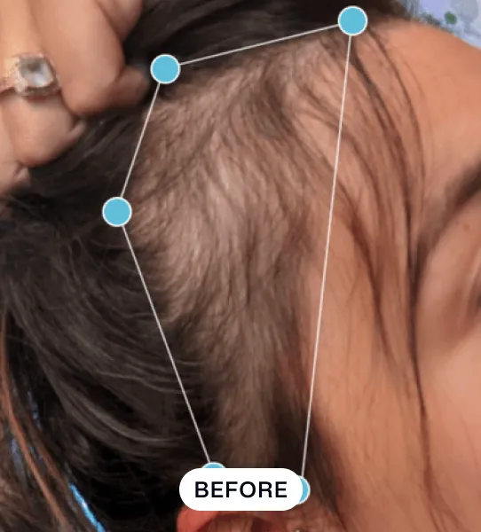 Close-up of a person's scalp with thinning hair near the forehead and temple, labeled 'BEFORE'.