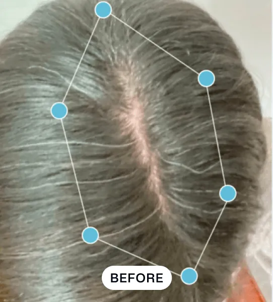 Top view of a person's scalp showing thinning hair along the center parting, marked with blue dots forming a polygon and the word 'BEFORE' below.