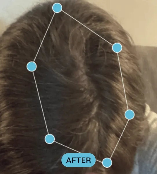 Top view of a person's head showing thick, dark hair with a central parting, marked by blue dots forming an irregular shape and labeled 'AFTER'.