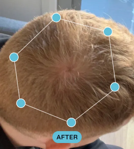 Top view of a person's head with short light brown hair showing scalp and hair growth pattern, labeled 'AFTER' with a hexagon connecting six blue dots around the crown area.