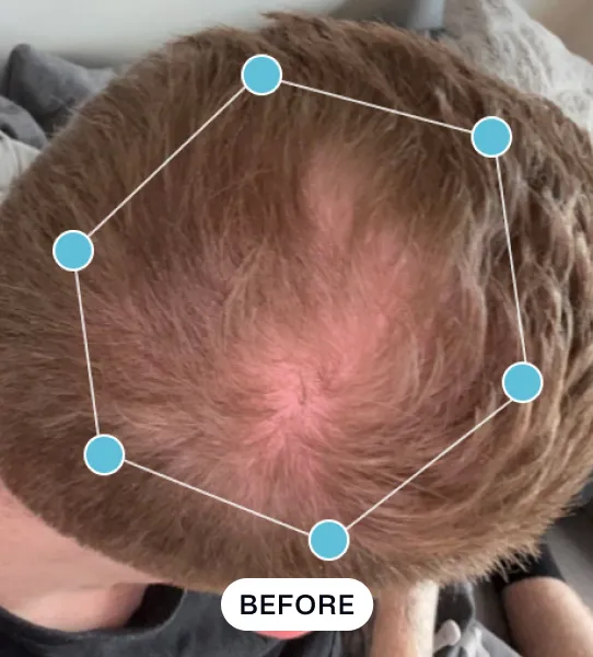 Top view of a person’s scalp showing thinning hair and reduced coverage, marked with a hexagon of six blue dots connecting lines. The word 'BEFORE' is displayed below the scalp area.