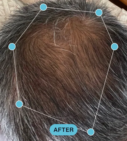 Close-up of the top of a person's head with mostly dark hair, some grey strands, and a small patch of thinner hair in the crown area, marked as 'After'.