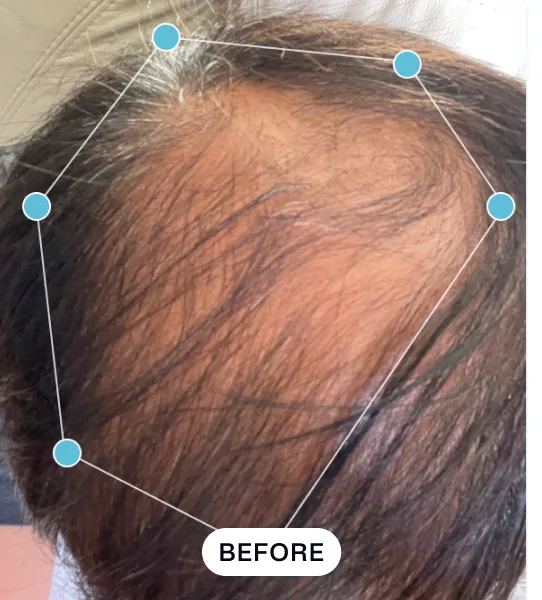 Close-up of a person's scalp showing significant hair thinning and bald spot on the crown, outlined by a white polygon with blue points and labeled 'BEFORE'.