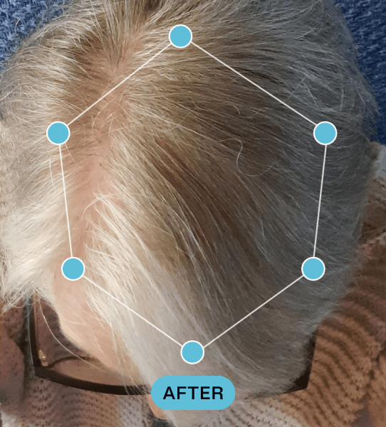 Top view of a person's head showing gray hair with a fuller appearance and less visible scalp, marked with blue nodes connected by thin lines forming a hexagon, labeled 'AFTER'.
