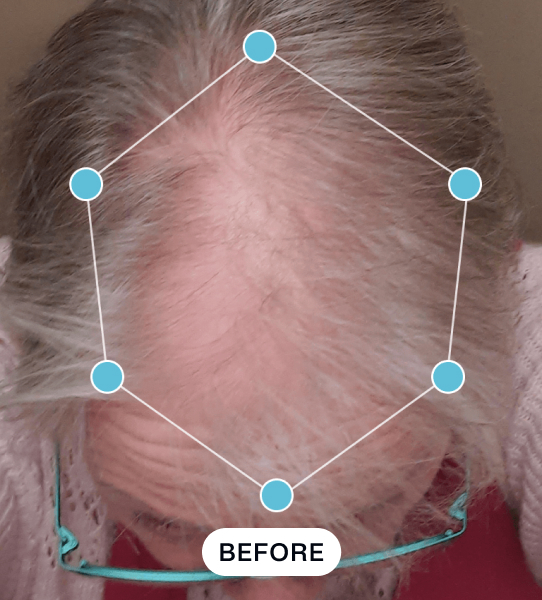 Top view of an older person with thinning gray hair and visible scalp, labeled 'BEFORE' with a hexagon shape overlay on the hair.