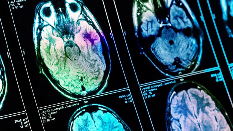 Ethnicity could play a role in surviving brain tumours, study finds