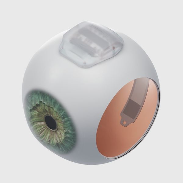 A render of the Science Eye inserted and secured against the inside of an eyeball