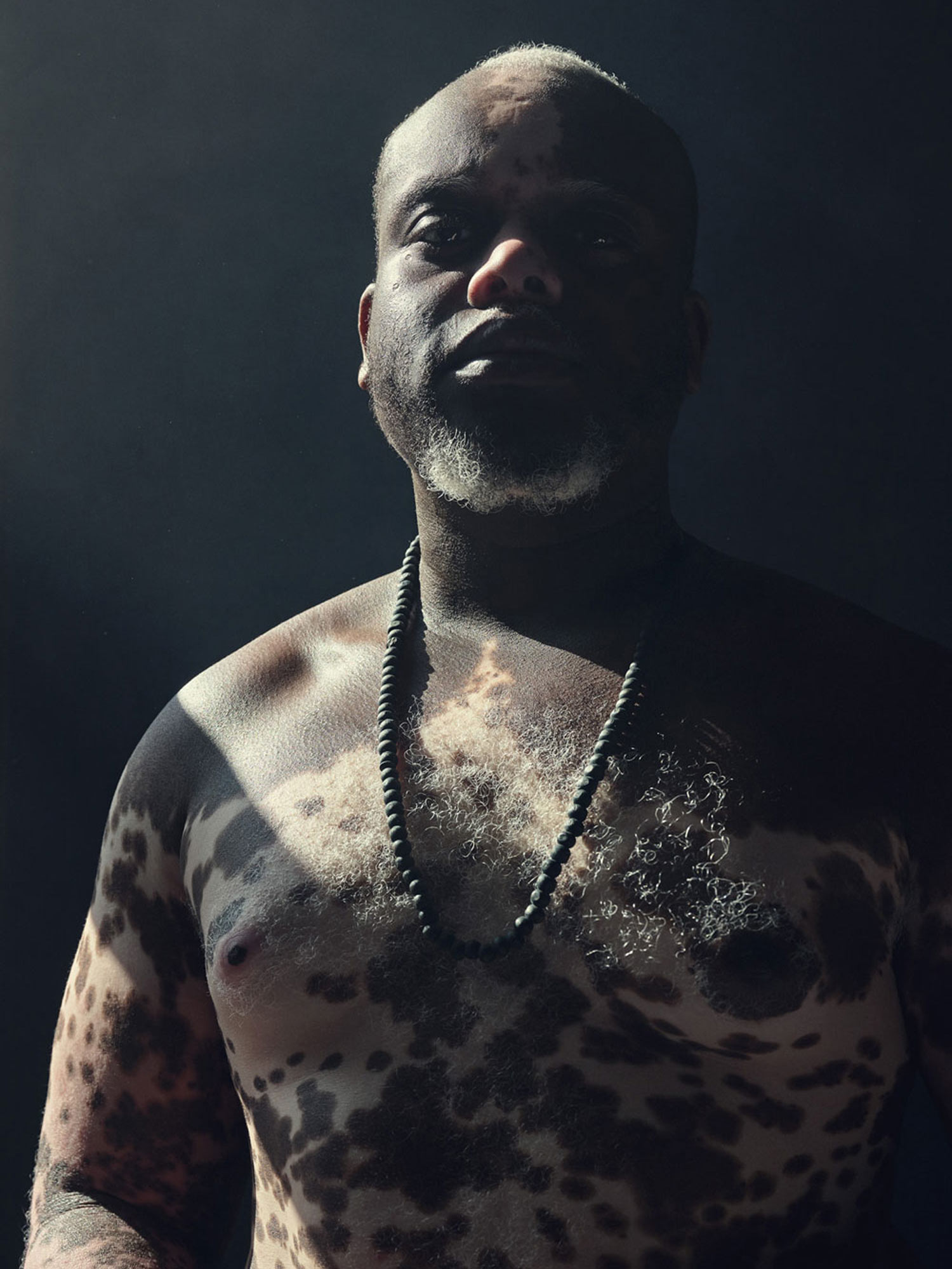 Vitiligo