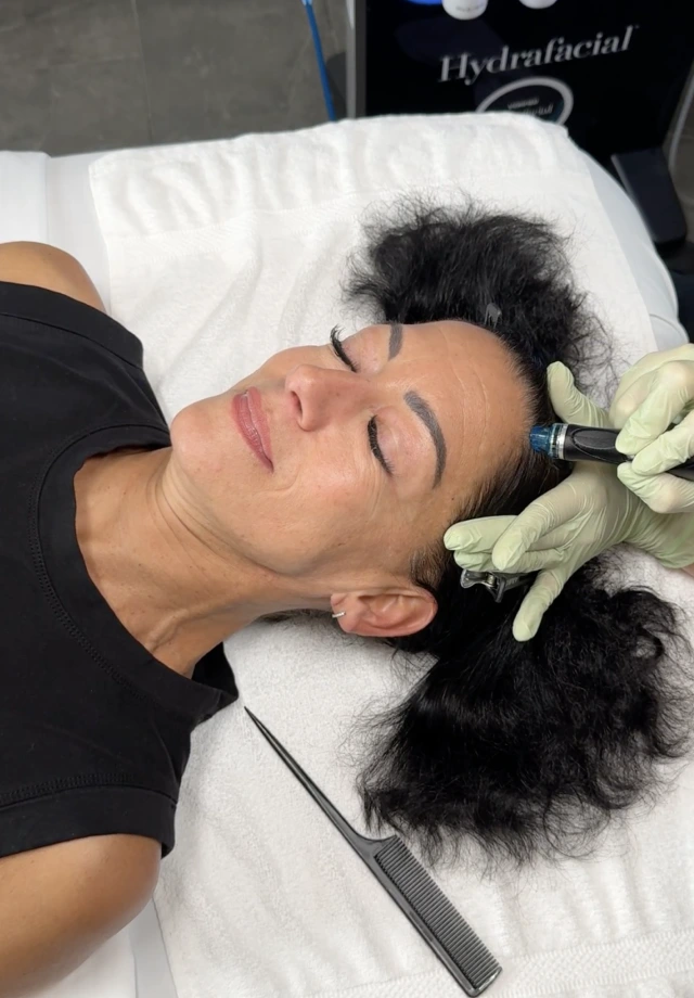 Woman receiving Keravive Scalp treatment