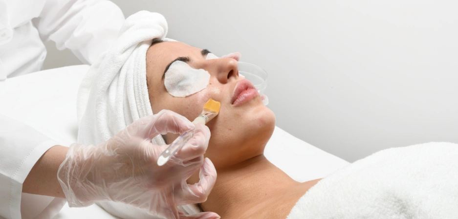 African American woman receiving a Marini Zero Downtime Peel