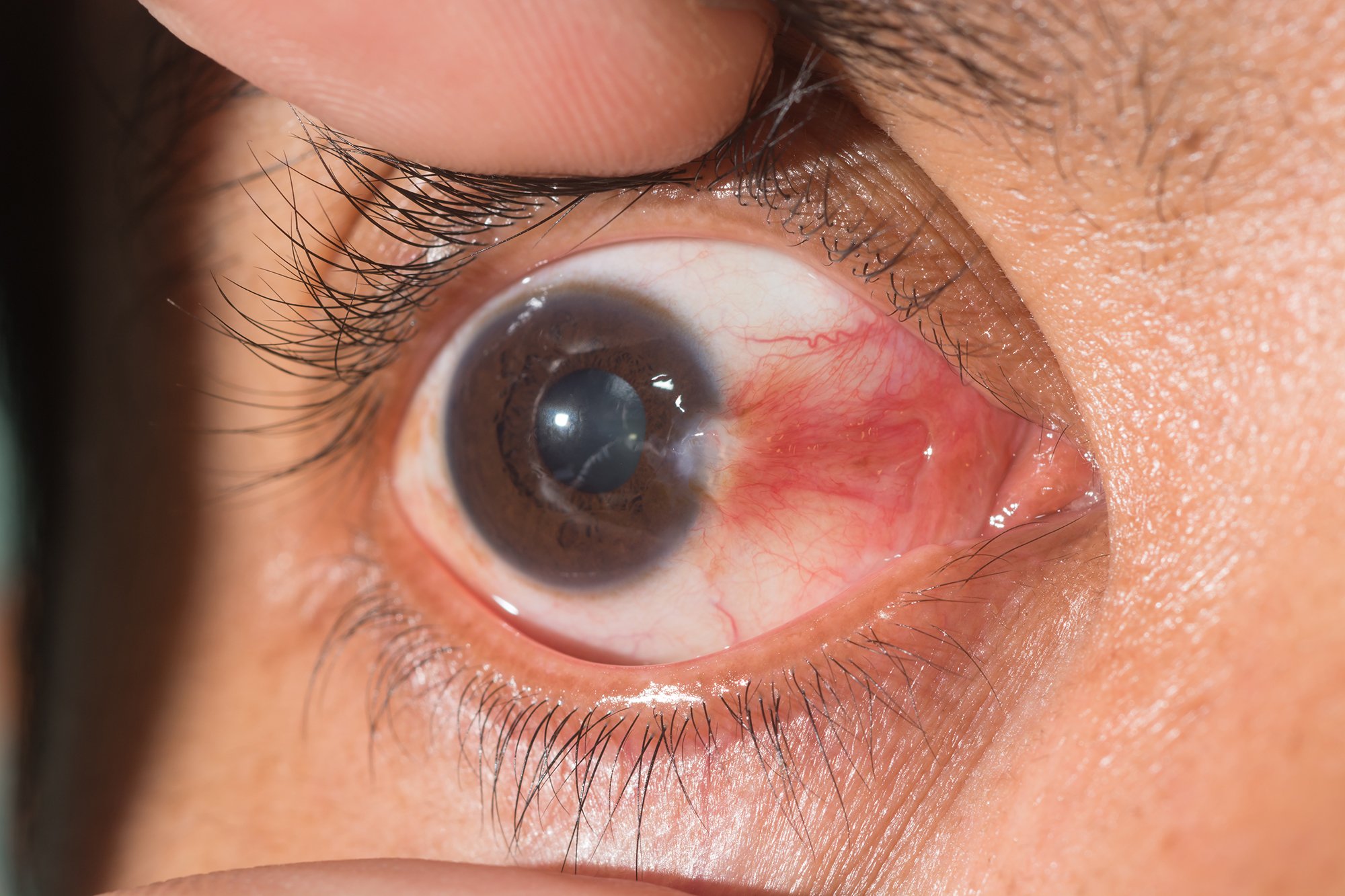 Surfer's Eye Explained: Everything You Need to Know About Pterygium