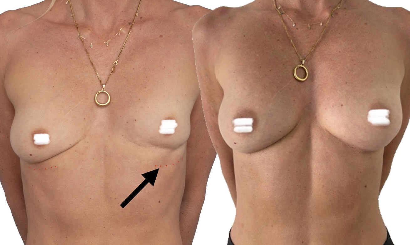 Revision of explant with completion capsulectomy, Pec major muscle repair and fat transfer.