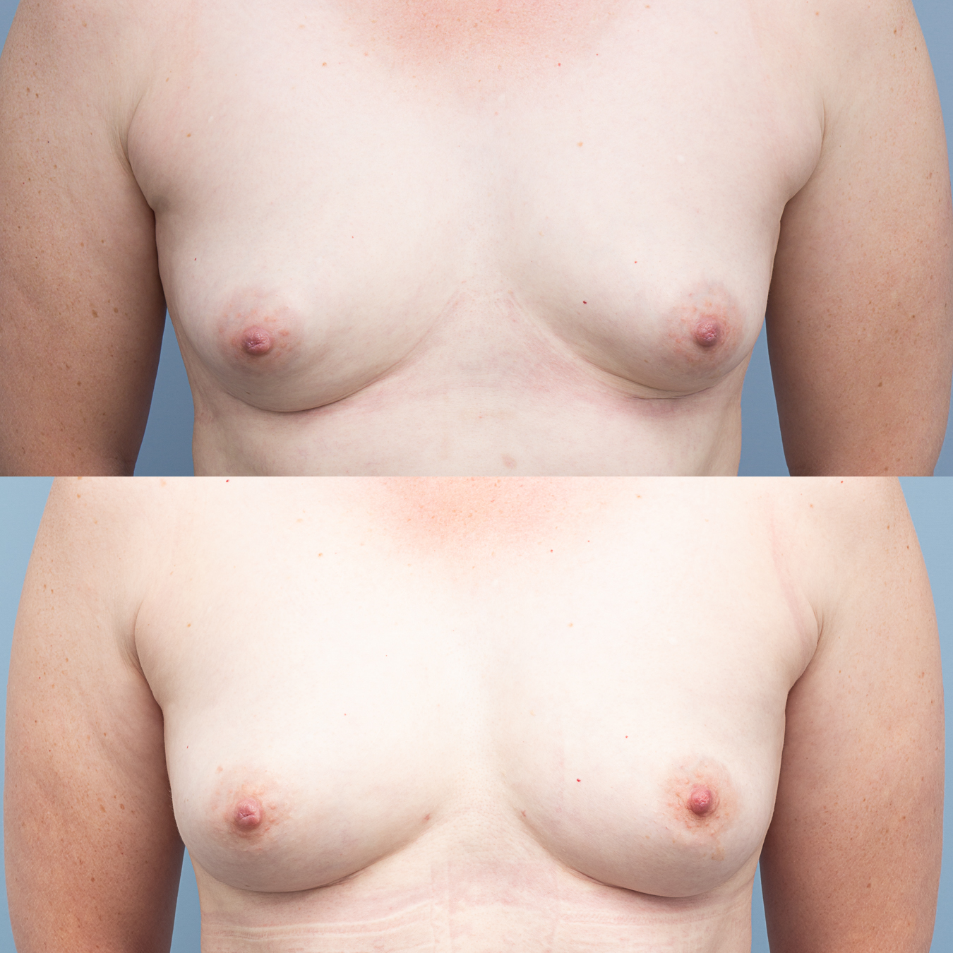 Revision of previous explant with completion capsulectomy, muscle repair and fat transfer.