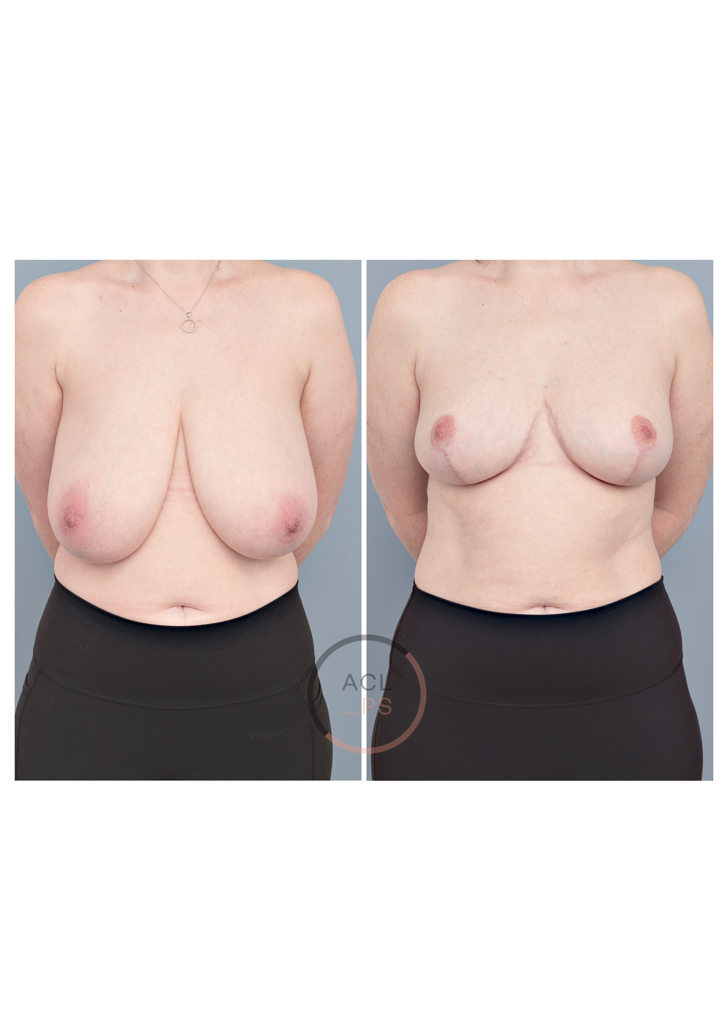 4 months after approx 600g reduction each breast.