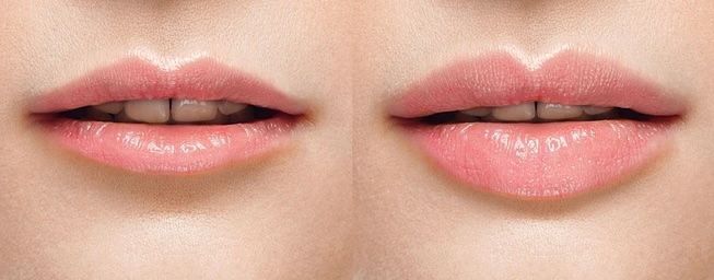 lip augmentation consultation