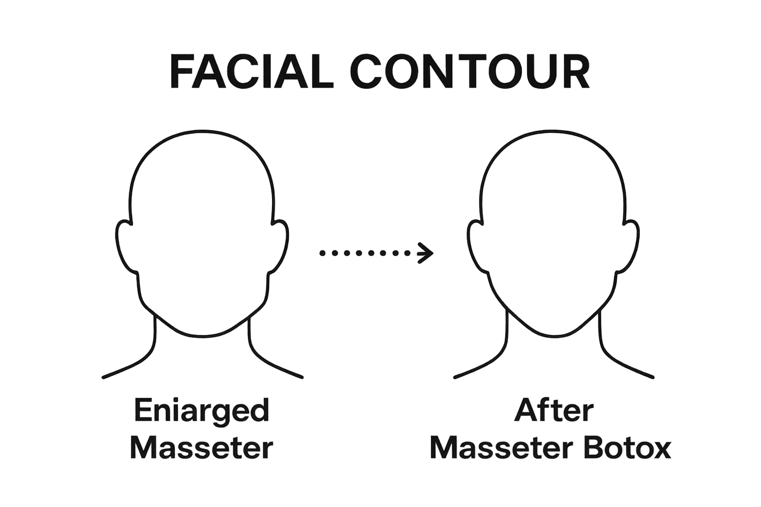 Before and after jawline outline showing masseter botox slimming effect