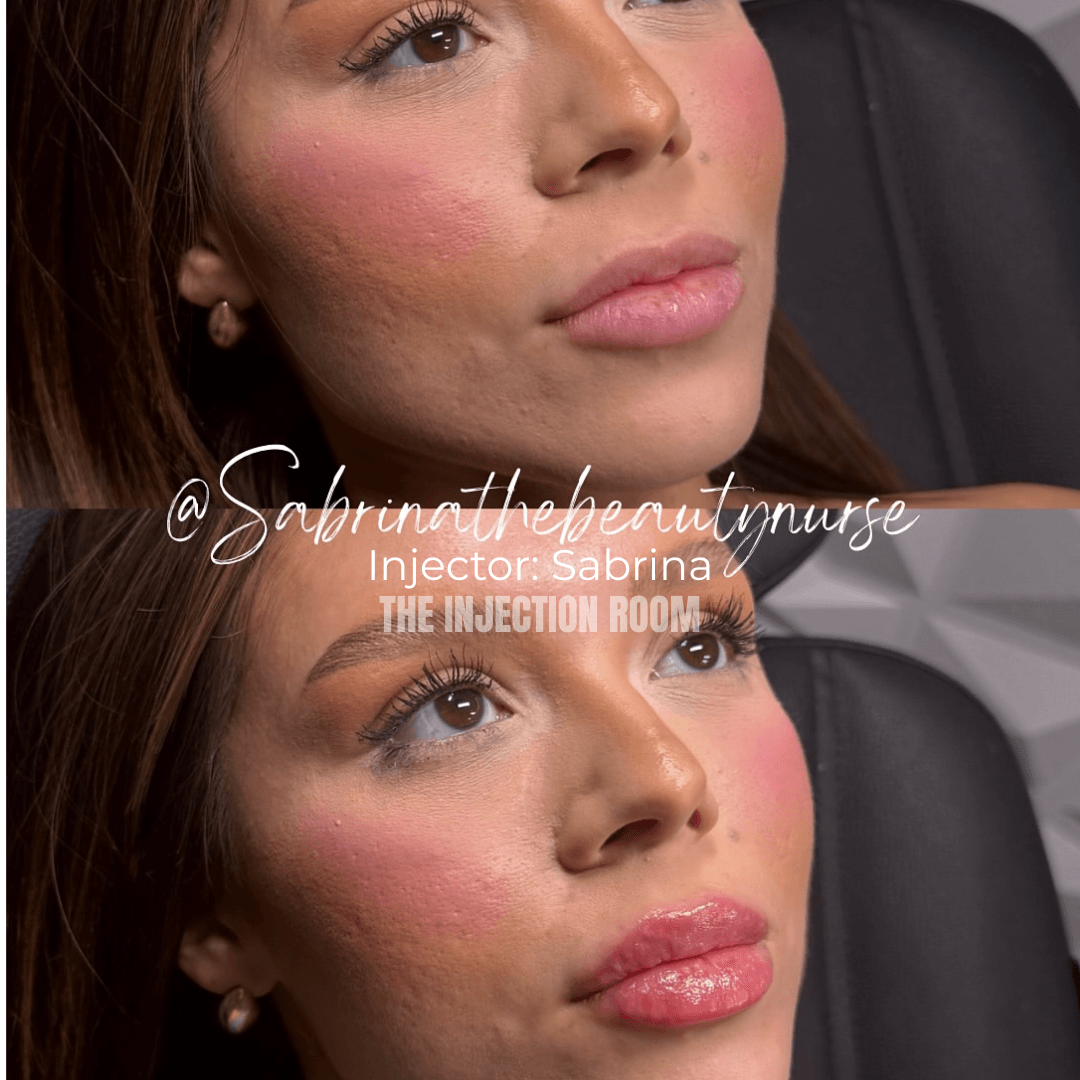 lip filler aftercare