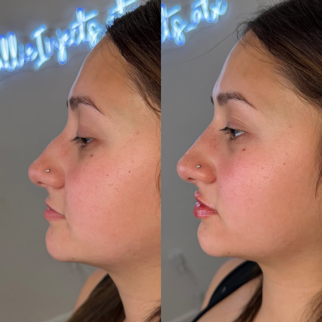 Simple visual comparison of surgical vs. non-surgical rhinoplasty