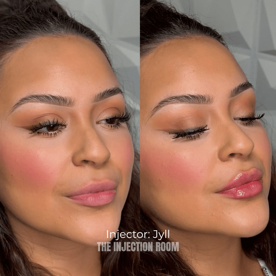 inyección de relleno labial